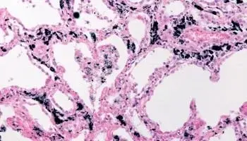 Silicosis: A Preventable Crisis Affecting Young Workers — Express Medicals